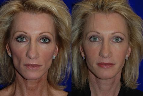 juvederm voluma xc injectable filler santa rosa  healdsburg