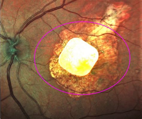 Implanted chip, natural eyesight coordinate vision in study of macular