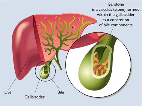 How do gallstones develop? - Mysurgeryabroad - Medicover Hospital ...