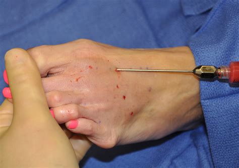 Feet Injections
