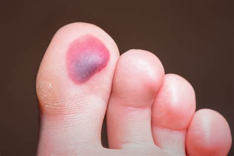 blisters  feet  podiatrists guide   treatment blister