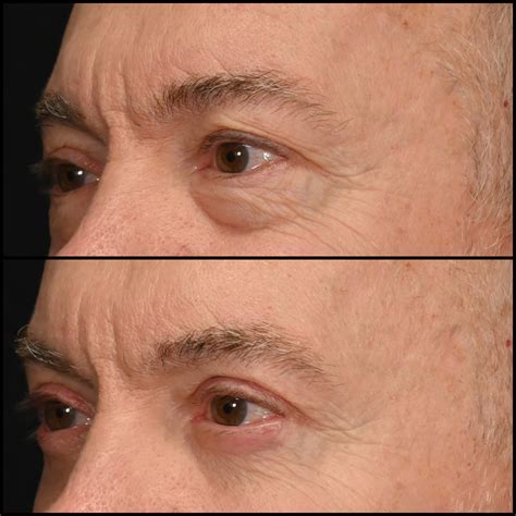 Lower Blepharoplasty Before & After Photos | Flora Levin MD