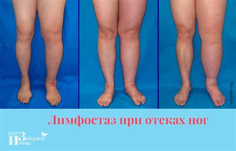 Почему отекают ноги - причины и лечение