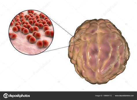 Pictures of staph infection on neck: MRSA Bacteria Photo 8 | MRSA