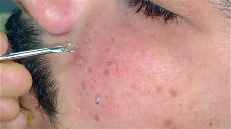 Expert Reveals: Unbelievable Blackhead Removal 2024 – The Ultimate Guide - 4f65stf