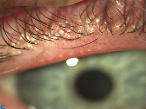 One-day silicone hydrogel as a therapeutic lens in a severely symptomatic case of meibomian ...