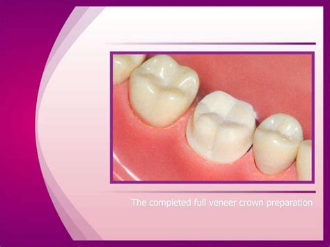 full veneer tooth preparation principals and steps | PPTX