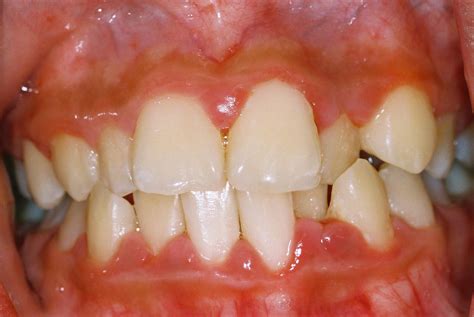 Family Dentistry: Gingivitis Treatment