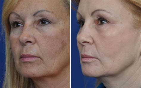 Laser Skin Resurfacing Before & After | Annapolis Plastic Surgery