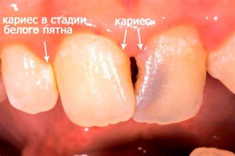 Откуда берётся "дырка" в зубе и почему она коричневая? | Твой ...
