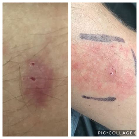 Centipede Bite