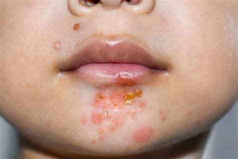 gross truth  impetigo coast dermatology skin cancer center