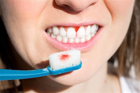 Why Are My Gums Bleeding | Dentist in Kingston, London.