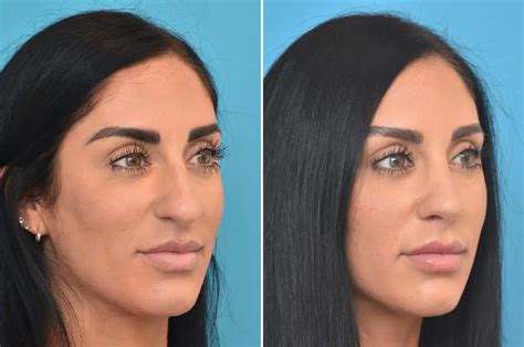 rhinoplasty    bulbous nose