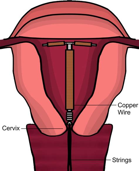 Copper Iud Vs Iud at Christopher Hess blog