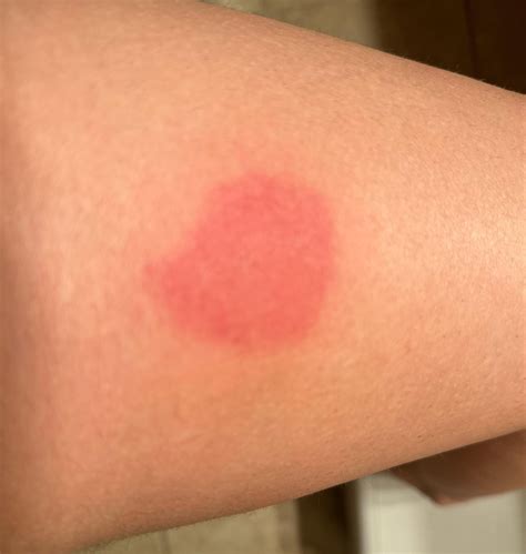 Injection Site Reaction : r/dupixent