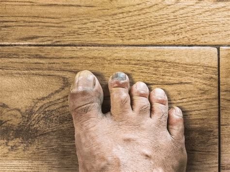 5+ Hundred Blue Black Toenail Royalty-Free Images, Stock Photos ...