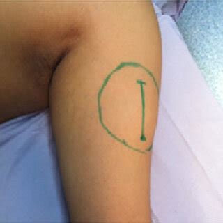 mass   lateral side   left upper arm  scientific diagram