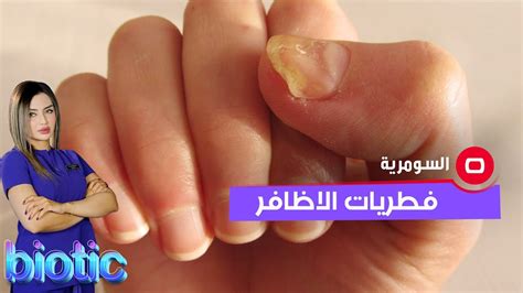 فطريات الاظافر واسبابها؟ - YouTube
