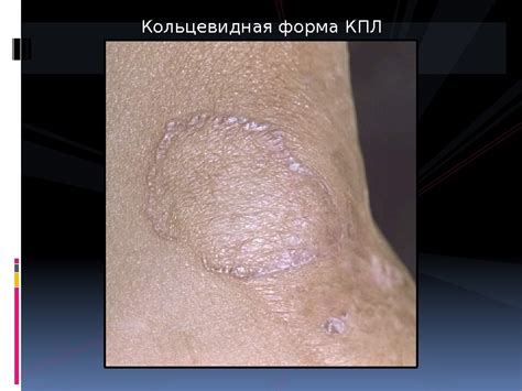 Презентация псориаз