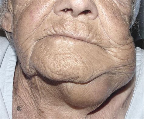 Myoepithelial carcinoma of the submandibular gland: report of a case ...