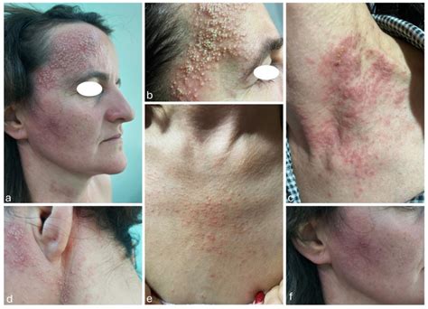 Unveiling a Therapeutic Breakthrough: Baricitinib in the Treatment of