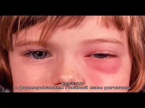 Флегмона глазницы - YouTube