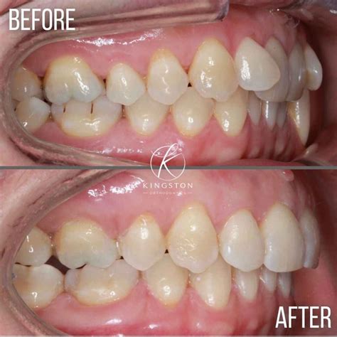 adult braces london affordable cost kingston orthodontics