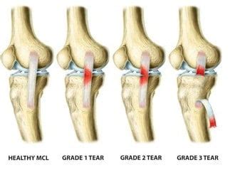MCL Sprain Recovery Time - Injury Health Blog