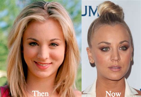 Kaley Cuoco Plastic Surgery Before and After Photos