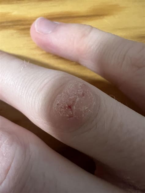 Is this a wart? : r/Warts
