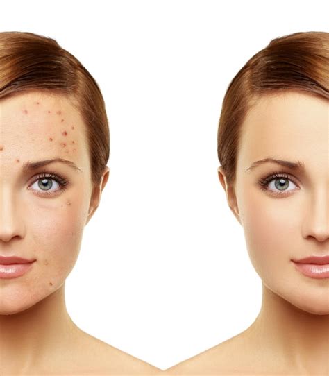 Premium Photo | Post Acne Marks Treating Acne Scars