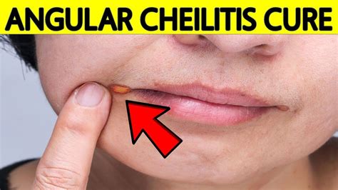 Severe Angular Cheilitis