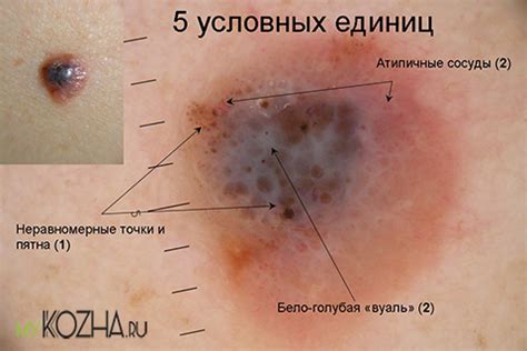Черная родинка на теле: причины почернения и появления черных точек на ...