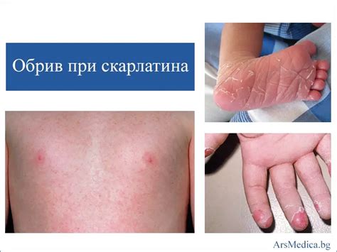 Обрив при скарлатина - характеристики | ArsMedica.bg