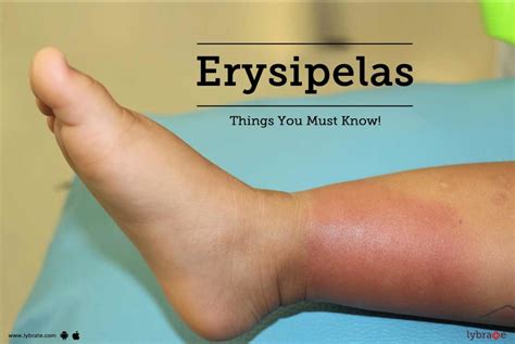 Erysipelas - Things You Must Know! - By Dr. Naik Homoeopathy | Lybrate