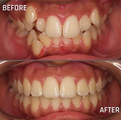 Crowded Teeth Before And After Braces