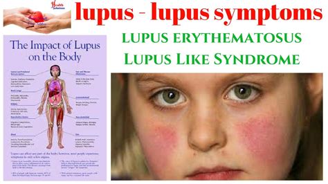 Lupus - Lupus Symptoms - Lupus Erythematosus - Lupus Like Syndrome ...