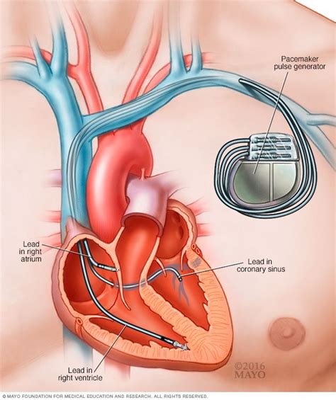 Pacemaker Implant in Pune - Dr. Rahul Sawant