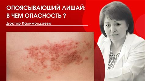 ОПОЯСЫВАЮЩИЙ ЛИШАЙ: В ЧЕМ ОПАСНОСТЬ? - YouTube