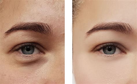 tear trough masterclass skin lab medical academy