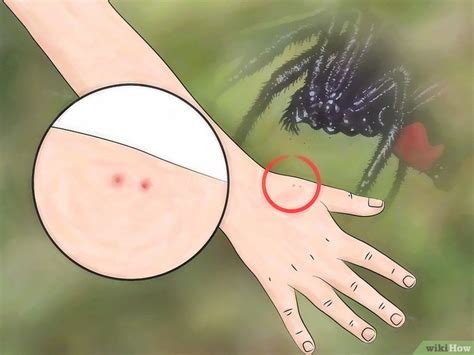 Picada De Aranha Fotos - Como Identificar uma Picada de Aranha: 7 Passos