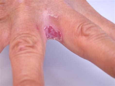 Skin Infections: Types, Symptoms, Pictures, & Treatment