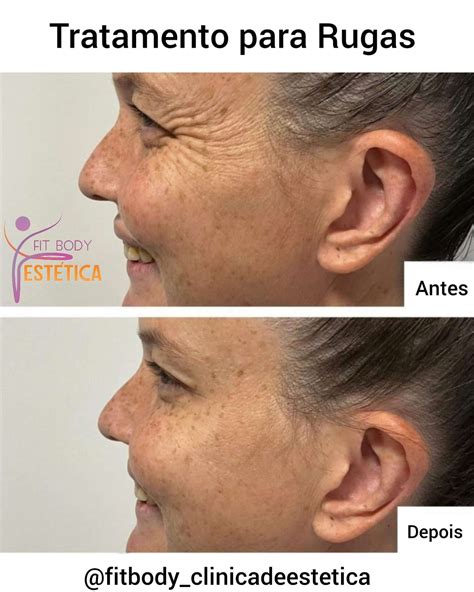 O Que É Bom Para Rugas - Como eliminar as Rugas de forma Natural e Eficaz? - Clínica Fit Body ...