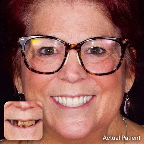 Full Mouth Dental Implants Dallas, TX | Doctors Implants