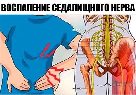 Воспаление седалищного нерва: достаточно 1 легкого упражнения, чтобы ...