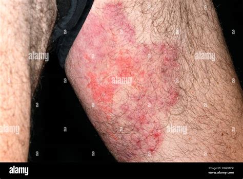 tinea   leg    year  female patient