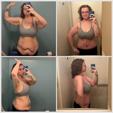 Loose Skin After Weight Loss Before And After: Real Transformations