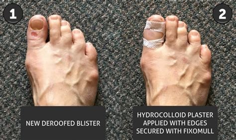 Hydrocolloid Healing: That White Gel Bubble - Blister Prevention