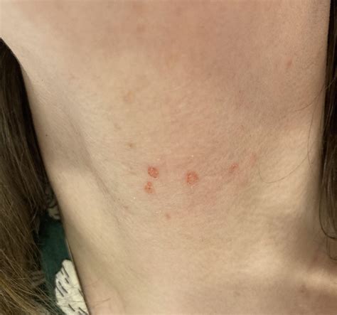 sudden red spots on neck : r/DermatologyQuestions